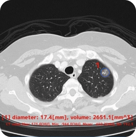 Chest CT with AI