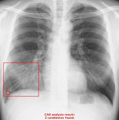 Chest X-ray with AI
