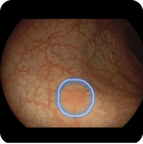 Colorectal colonoscopy with AI