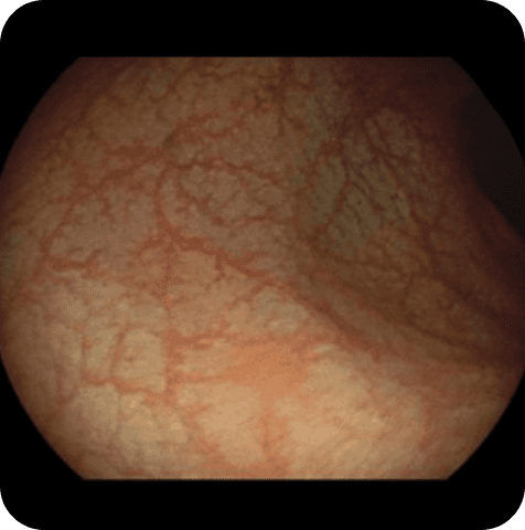 Colorectal colonoscopy original