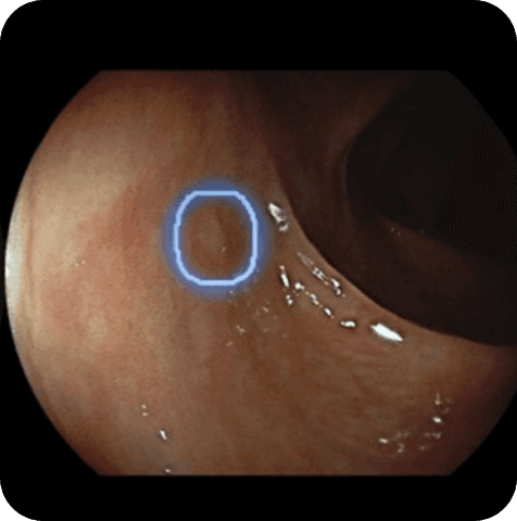 Gastric endoscopy with AI