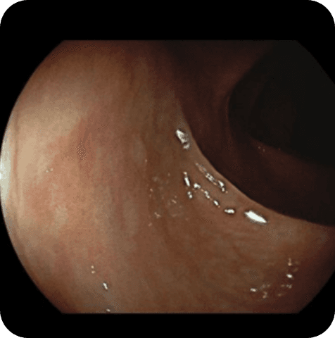 Gastric endoscopy original